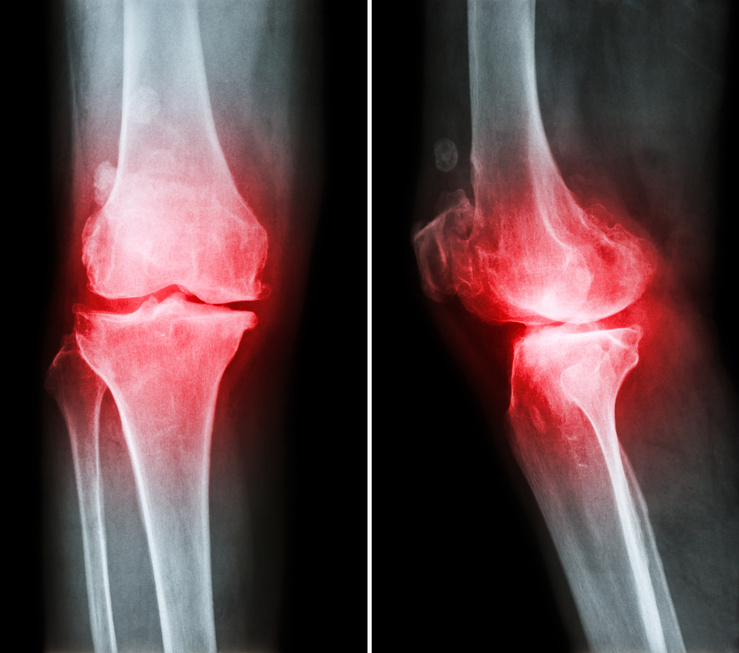 Osteoarthritis knee